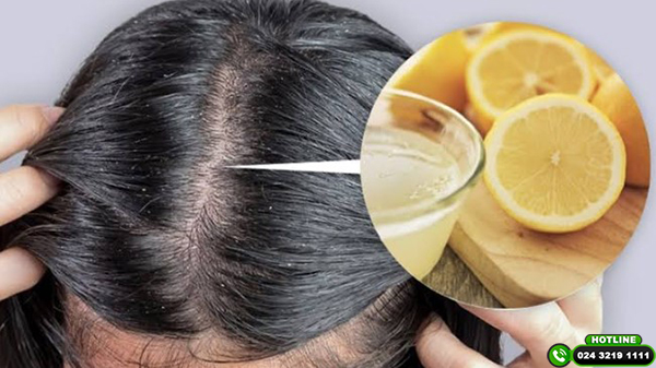 Cách trị gàu và rụng tóc