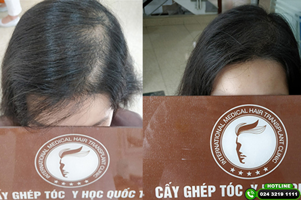 cấy tóc tự thân