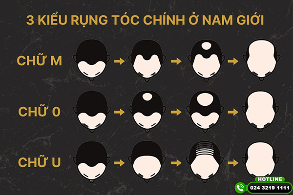 3 kiểu rụng tóc chính ở nam giới