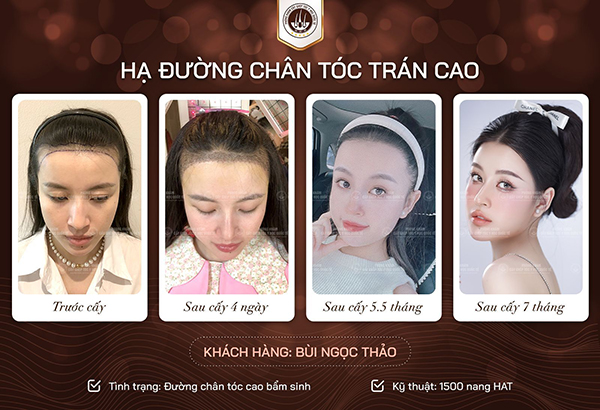 cấy tóc tự thân
