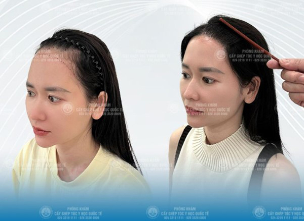 cấy tóc tự thân