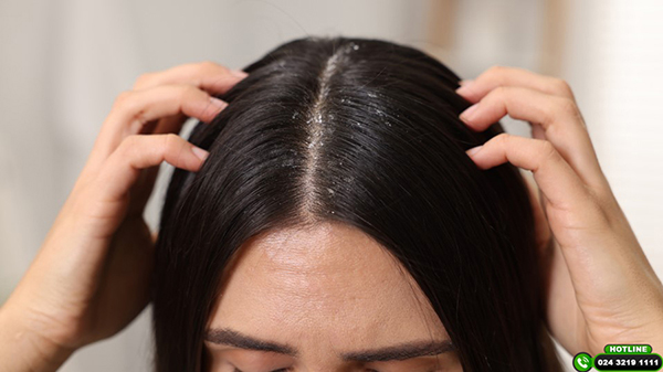 Bị gàu và rụng tóc: Nguyên nhân và cách điều trị dứt điểm
