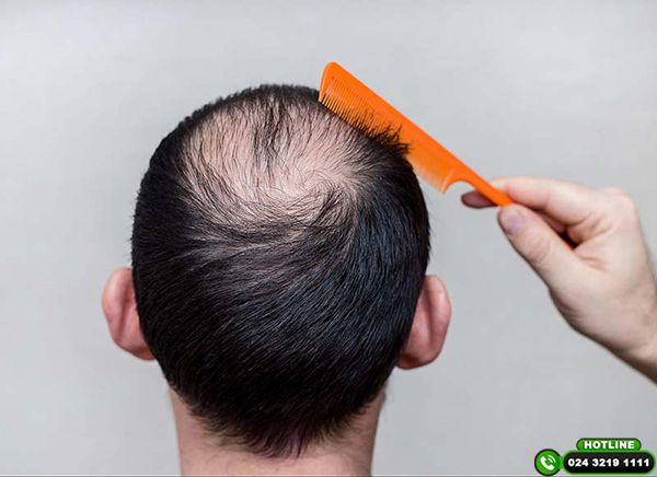 Tổng hợp các cách trị hói đầu di truyền hiệu quả hiện nay