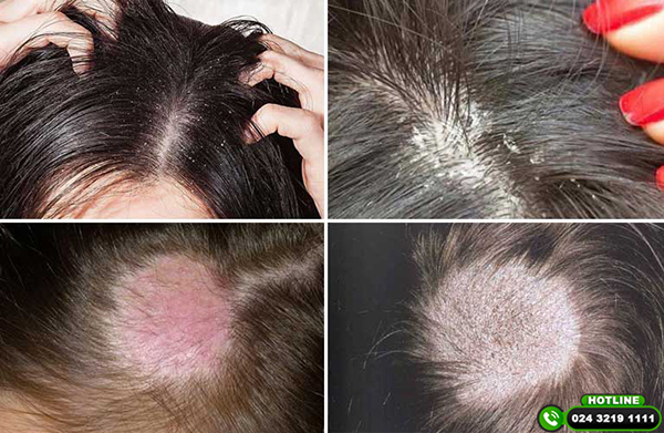nguyên nhân tóc rụng nhiều