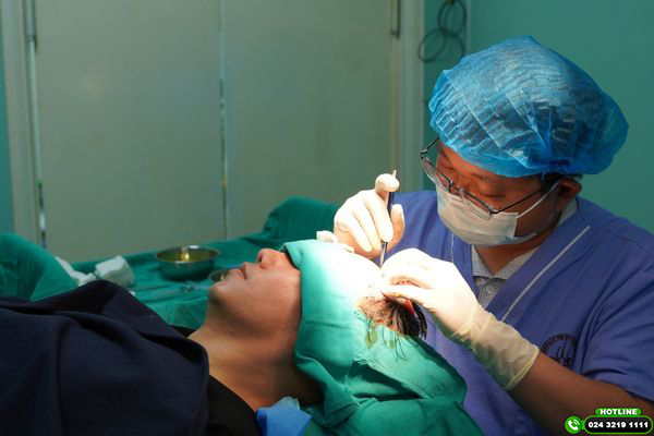cấy tóc tự thân