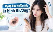 [Góc giải đáp] Rụng bao nhiêu tóc là bình thường?