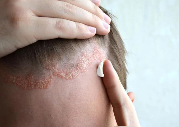 Khắc phục viêm da đâu