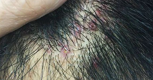 viêm nang lông da đầu